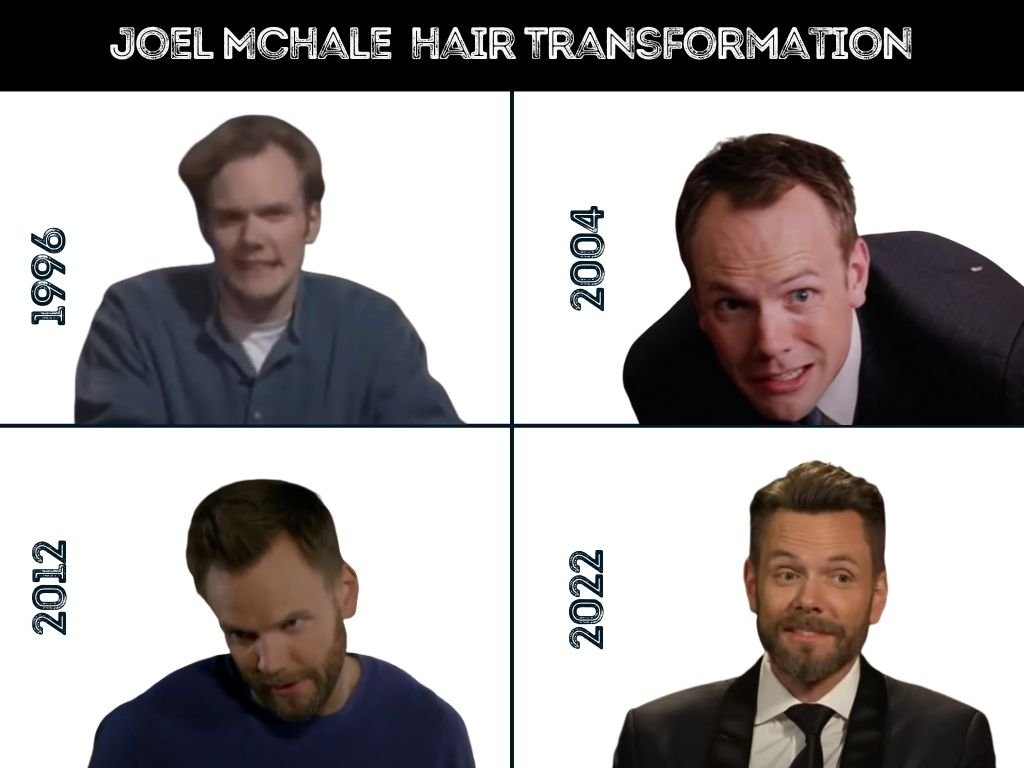 Expert Insights: Joel Mchale Hair Transplant – What You Need To Know